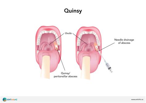 Peritonsillar abscess (Quinsy) - ENT Info