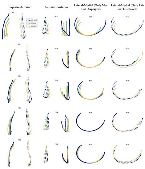 JPM | Special Issue : Patient-Specific Implants in Musculoskeletal ...