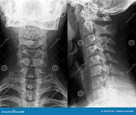 Normal Cervical Spine