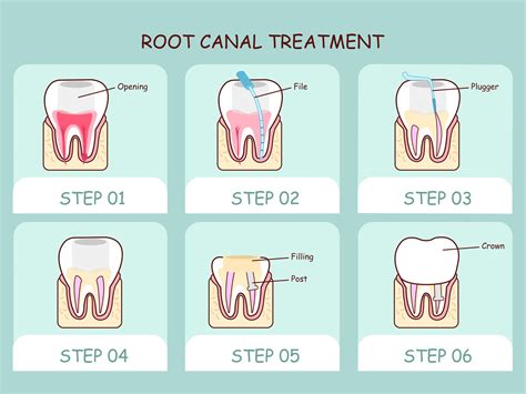 Root Canal Symptoms Of Failing