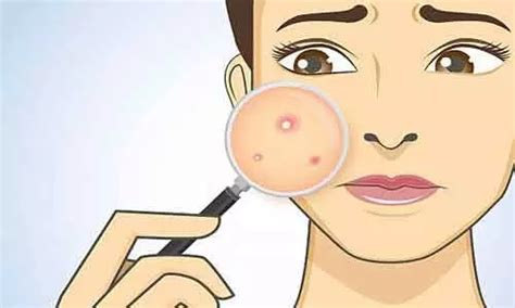 Metformin effective against PCOS related acne: Study