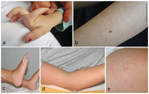 Kollagen-VI-assoziierte Erkrankungen der Muskulatur - Neurologie ...