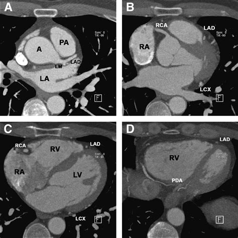 Coronary CT Angiography | Journal of Nuclear Medicine