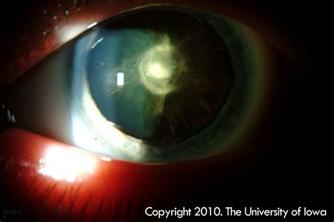 Posterior Polar Cataract. EyeRounds.org - Ophthalmology - The ...