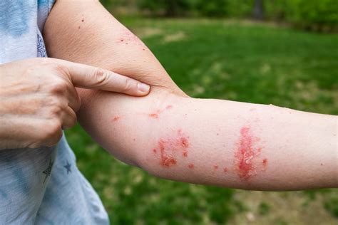 What is a Poison Ivy Rash? Symptoms, Treatment & Prevention | Ivarest®