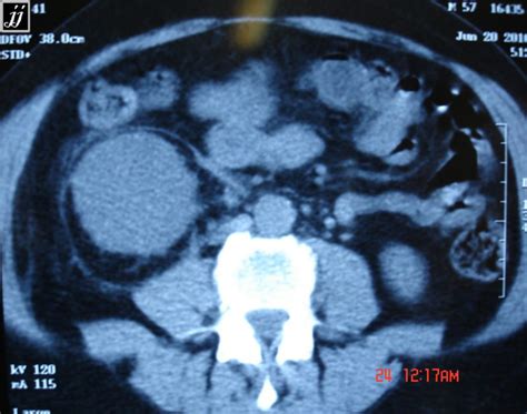 Abdomen – Kidney tumor, CT Scan - Radioogle