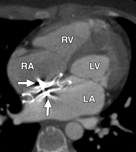 MDCT Evaluation After Closure of Atrial Septal Defect with an Amplatzer Septal Occluder | AJR