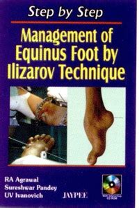 Step by Step: Management of Equinus Foot by Ilizarov Technique: Buy ...