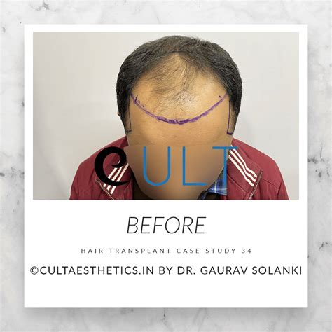 Hair Transplant Case Study 34 | Cult Aesthetics