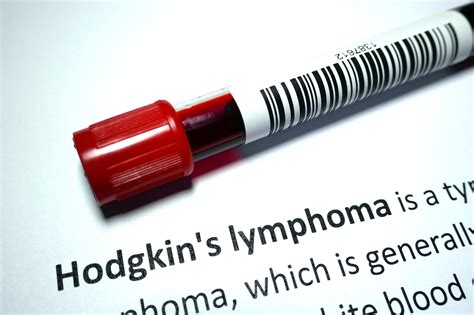 Stanford’s Innovative Blood Test Offers New Hope for Hodgkin Lymphoma Patients