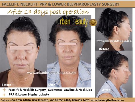 Face Surgery Cost In Thailand