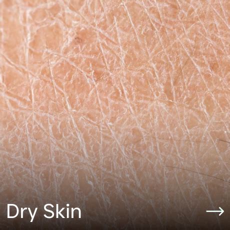 Hyperpigmentation in Indian Skin: Causes, Prevention & Treatment ...