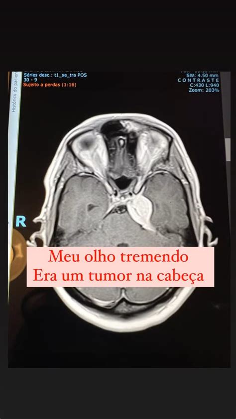 Mujer vivió dos años con un temblor en el ojo sin saber que tenía un ...