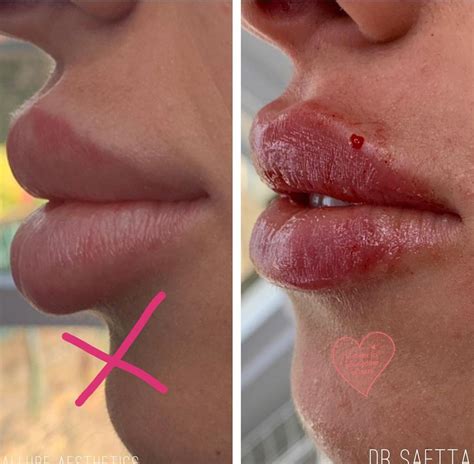 Pin by CyGht on chirurgie | Botox lips, Facial fillers, Lips inspiration