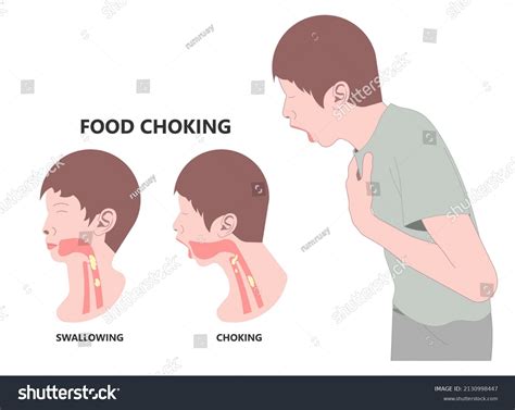 1,121 Choking Help Images, Stock Photos & Vectors | Shutterstock