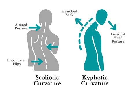 Kyphosis Vs Lordosis