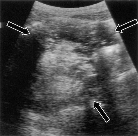 Ovarian Teratomas: Tumor Types and Imaging Characteristics | RadioGraphics