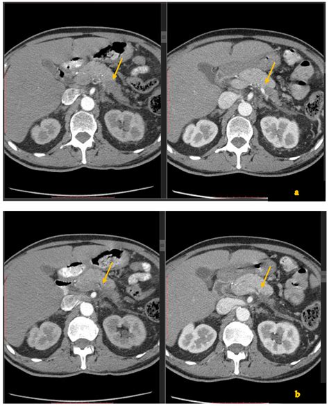 Pancreatic Cancer Resectability After Neoadjuvant Treatment: An Imaging ...