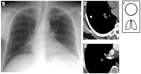 Non Calcified Lung Nodule