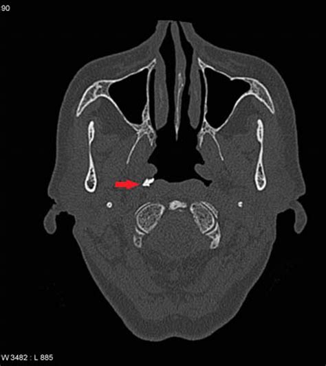 Rhinolith in the fossa of Rosenmüller – a hidden stone | BMJ Case Reports