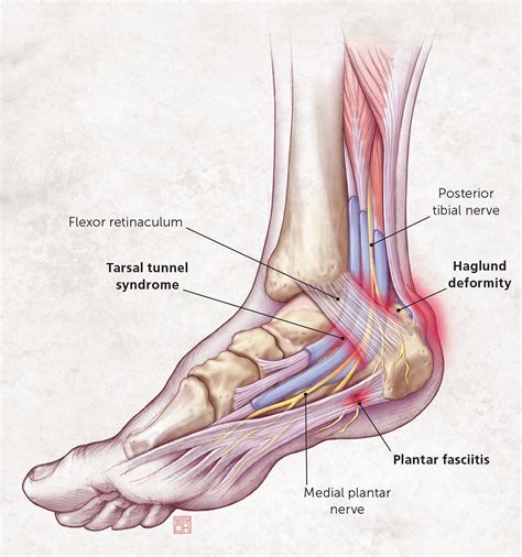 Heel Pain: Diagnosis and Management | AAFP