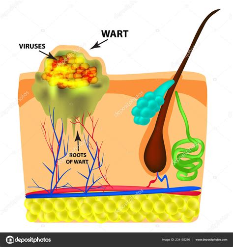 Plantar Wart Root Diagram Bruin Blog