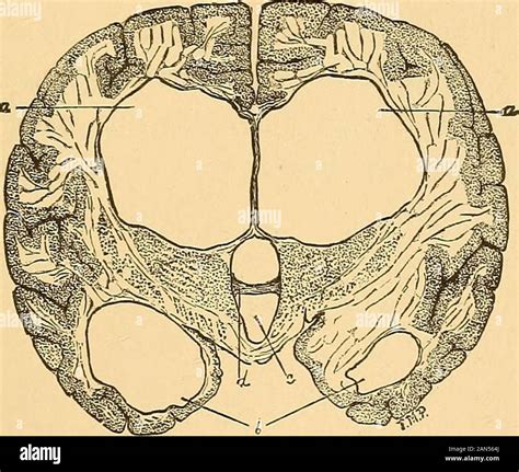 Brain surgery . d to be made one and one-fourthinch above and one and ...