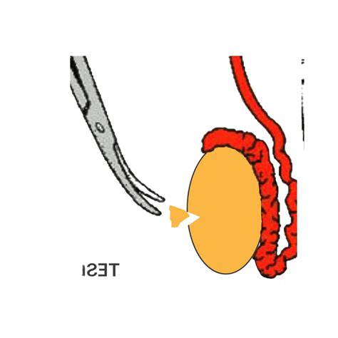 Vasectomy Reversal vs IVF: Choosing the Best Path to Parenthood