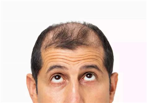 Androgenetic Alopecia: Home remedies that can actually help reverse ...