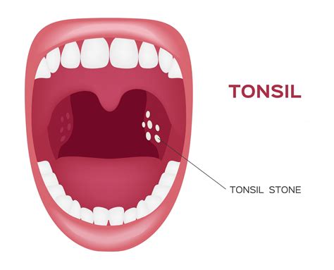 White Spots On Tonsils Stones