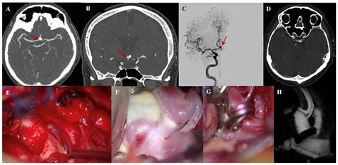 Preliminary Experience with Extradural Clinoidectomy and Lamina ...