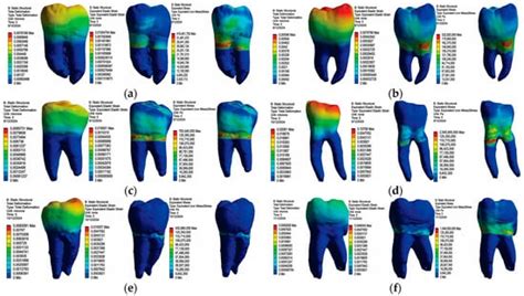 A Finite Element Method Study of Stress Distribution in Dental Hard ...