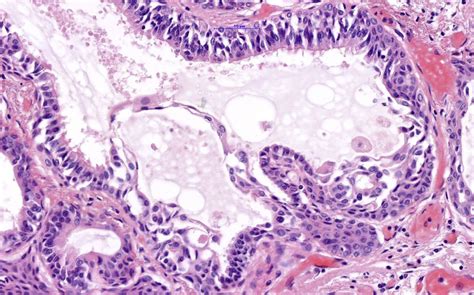 Eine neue Entität mit fraglicher Dignität - Pathologie - Universimed ...