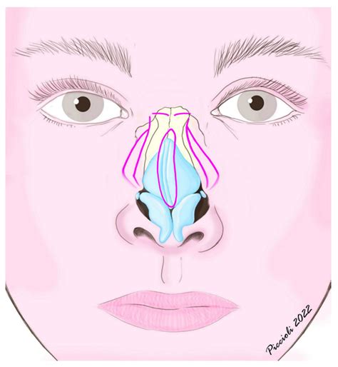 JPM | Free Full-Text | Double Lateral Osteotomy: Not Only the ...