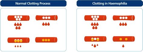 Understanding Haemophilia