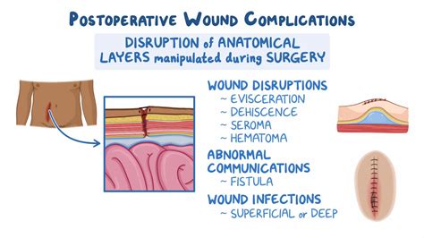 Surgical Wound Dehiscence Treatment at Herman Stpierre blog