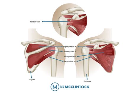 Rotator Cuff Injury Test at Home - Kyle McClintock, DO | Orthopedic Surgeon Roseville, CA