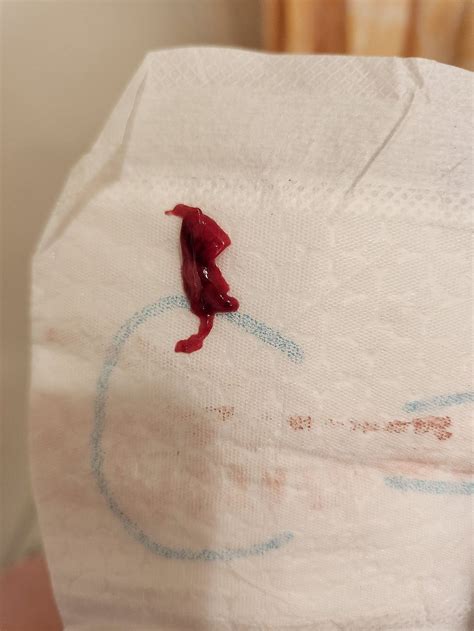 Is this a miscarriage? *Graphic* | BabyCenter