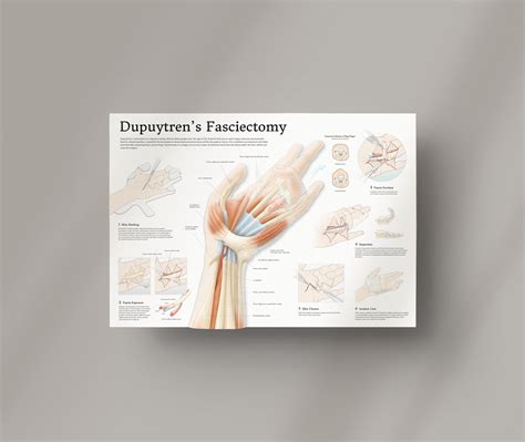 Dupuytren's Contracture Surgery