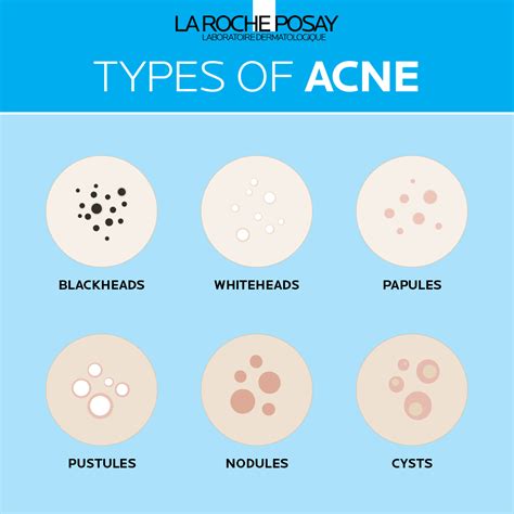 Difference Between Acne vs Pimples | La Roche-Posay® Australia & NZ