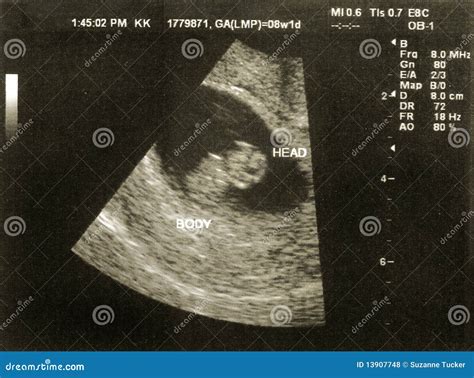 Ultrasound of a Fetus at 8 Weeks 1 Day Stock Photo - Image of ...