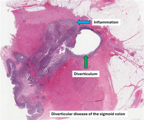 Diverticular disease – MyPathologyReport
