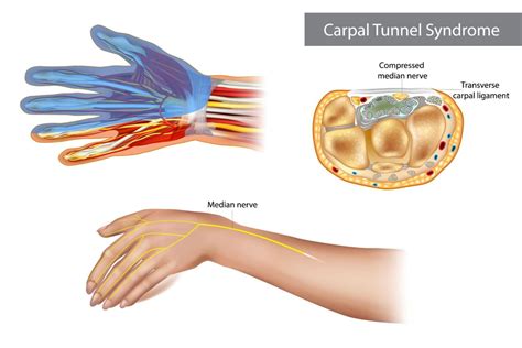 Physical Therapy For Carpal Tunnel | Evolution Physical Therapy