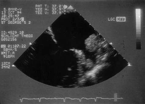 Left atrial appendage: structure, function, and role in thromboembolism | Heart