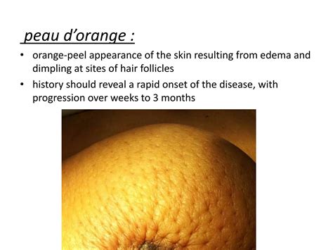 Locally advanced breast cancer | PPTX