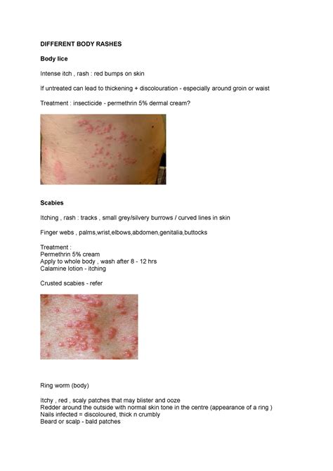 Different BODY Rashes - body rash summary for OSCE - DIFFERENT BODY RASHES Body lice Intense ...
