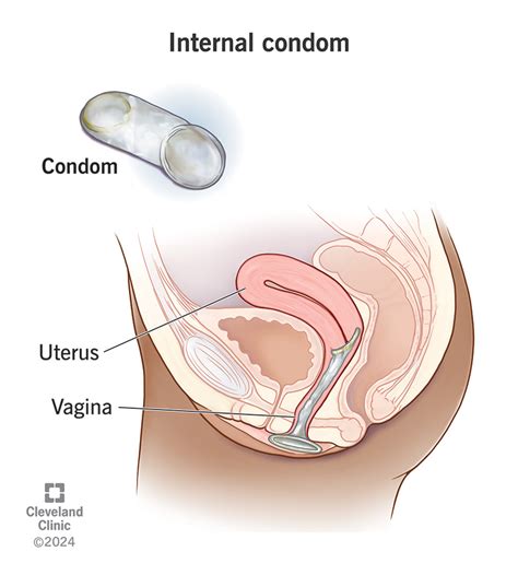 Image result for How Does a Condom Work