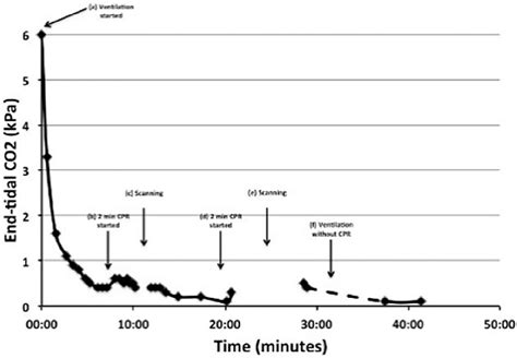 END-TIDAL CO2 DETECTION DURING CADAVERIC VENTILATION | Emergency ...