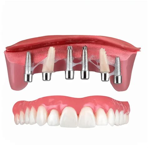¿Qué esperar tras una cirugía de implantes dentales?