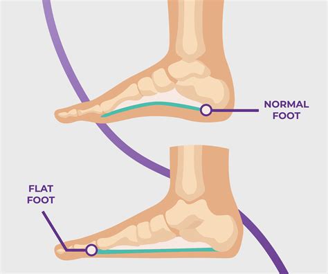 Flat Feet In Children: Causes, Symptoms & Treatment